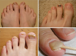 Symptoms of nail fungus