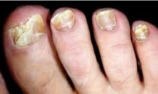 The danger of onychomycosis