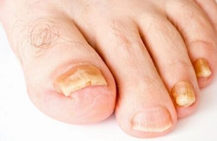 yellowing of the toenails with fungus