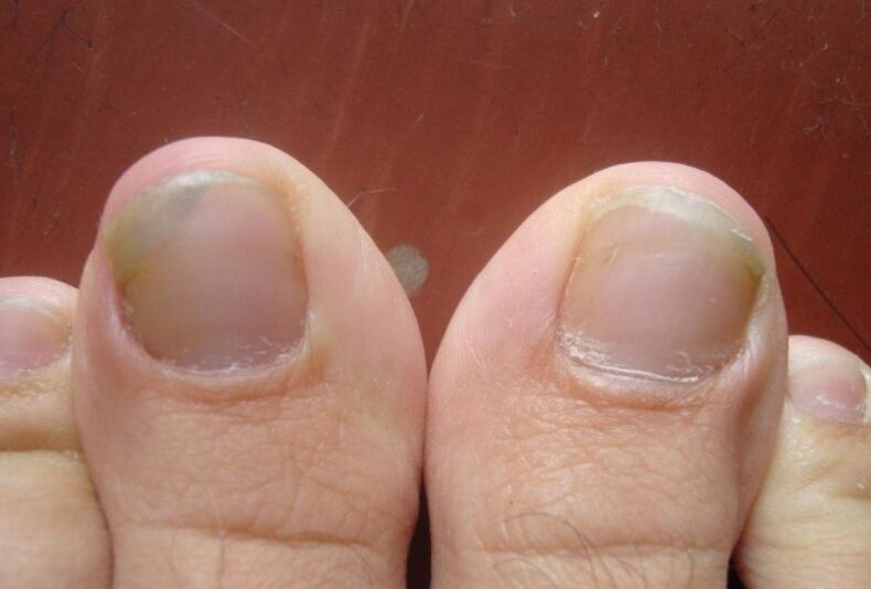 The initial stage of toenail fungus