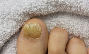 the nail fungus