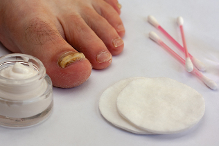 the fungus toe