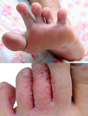 The foot mushroom